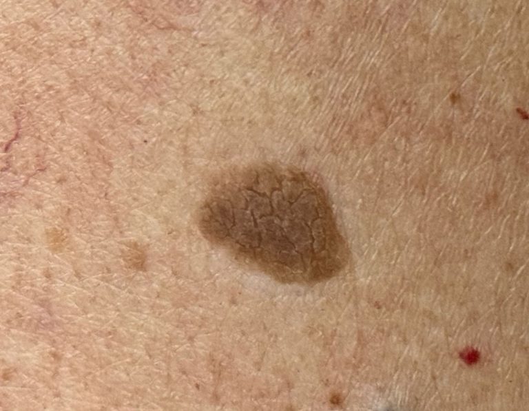 Ouderdomswrat leeuwarden behandelen