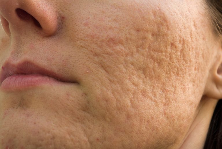 acne-littekens-gezicht_35-min