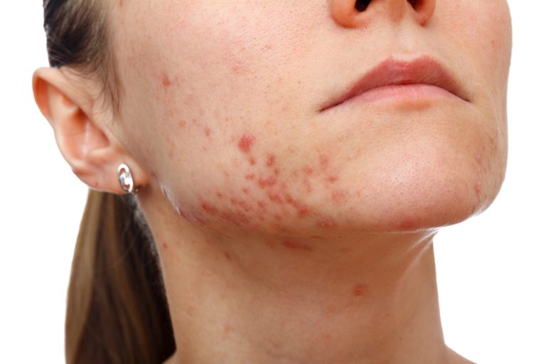 acne-vrouw_35-min