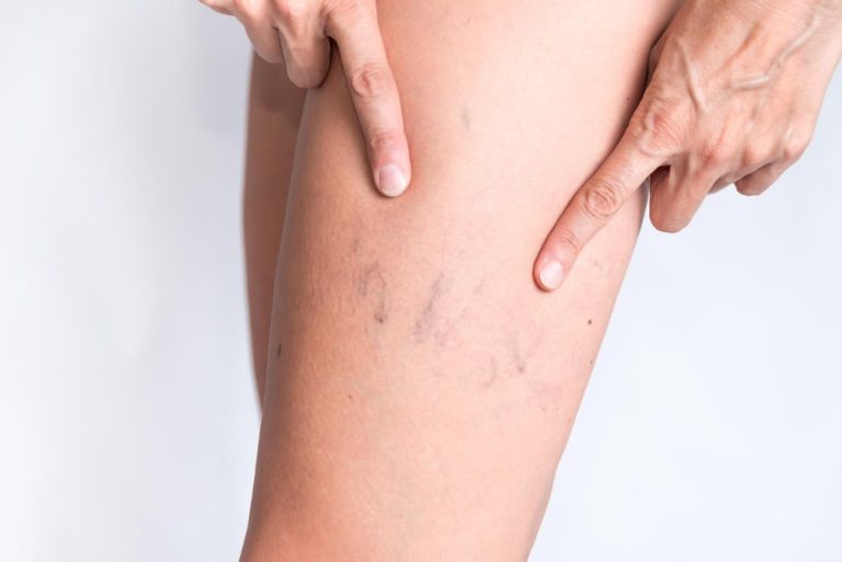 varicose veins