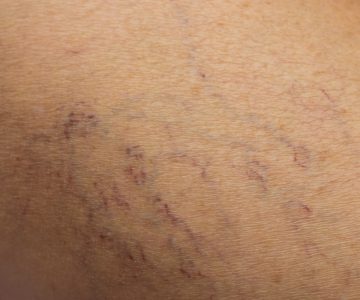 Inspuiten van spataders (sclerotherapie)2