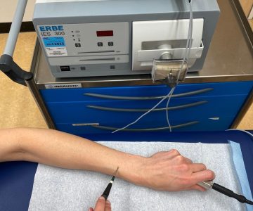 elektrocoagulatie behandeling leeuwarden voorbeeld